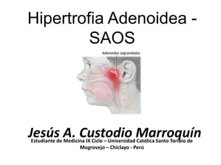 Hipertrofia Adenoidea -
         SAOS




Jesús A. Custodio Marroquín
Estudiante de Medicina IX Ciclo – Universidad Católica Santo Toribio de
                    Mogrovejo – Chiclayo - Perú
 