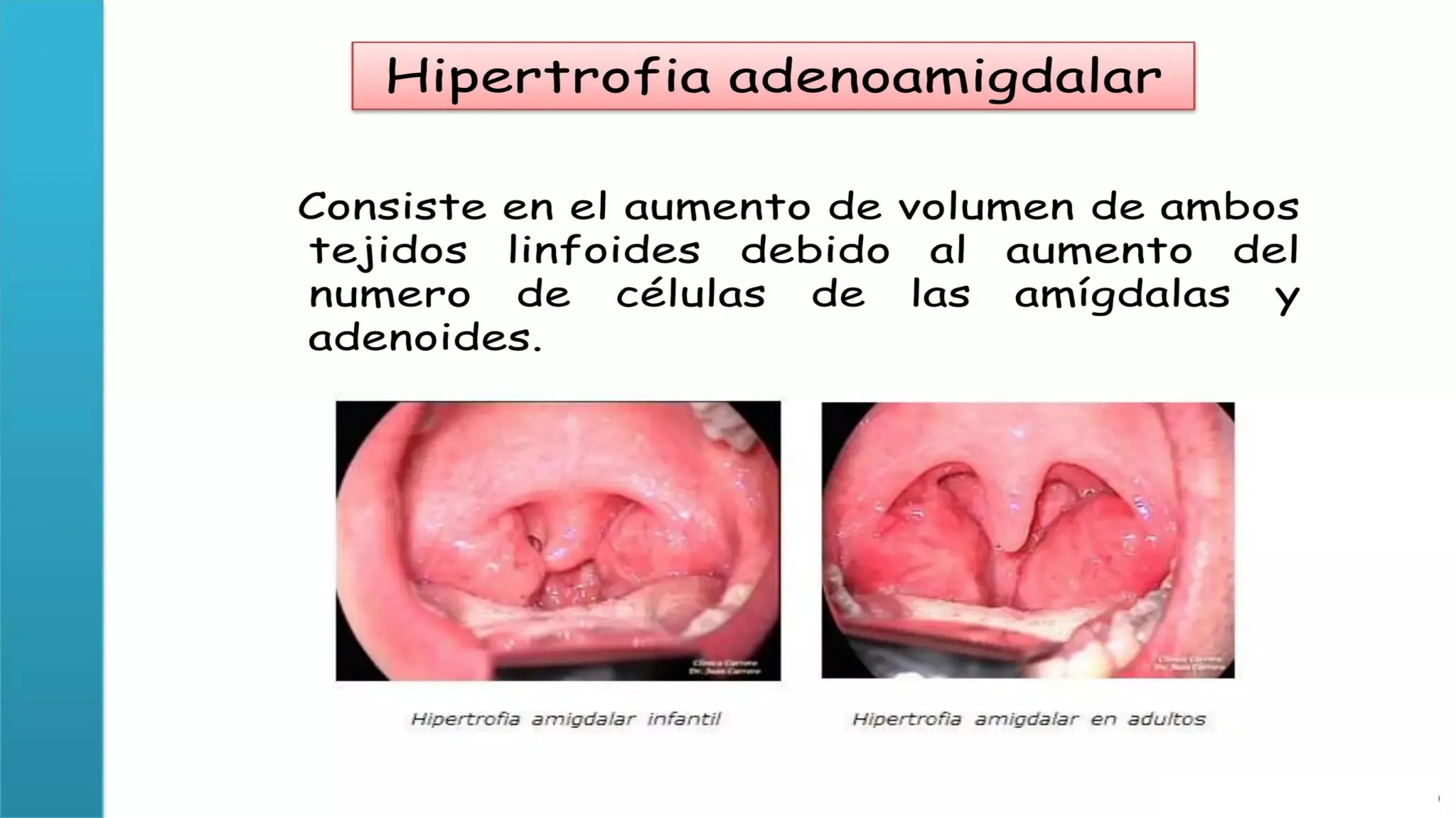 HIPERTROFIA AMIGDALINA MEDICINA FAMILIAR.pptx