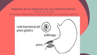 Diagrama de un estómago con una estenosis pilórica
-Fíjese en el corte
transversal mostrando el estrechamiento de la aber...