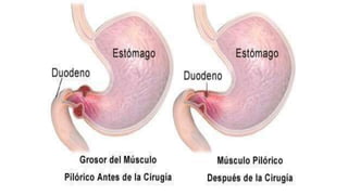 DIAGNOSTICO DIFERENCIAL
 vólvulo intestinal(asociado o no a una rotación
anómala).
 hernias encarceladas con datos de ob...
