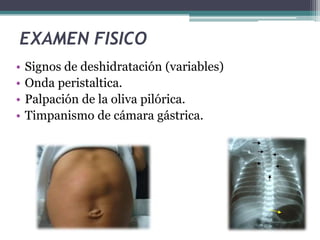 Hipertrofia congénita de píloro | PPTX