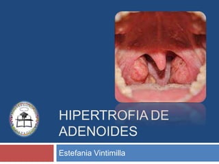 HIPERTROFIA DE
ADENOIDES
Estefania Vintimilla
 