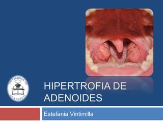 HIPERTROFIA DE 
ADENOIDES 
Estefania Vintimilla 
 