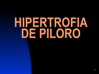 HIPERTROFIA DE PILORO 