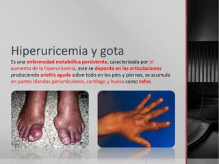 Hiperuricemia y gota
Es una enfermedad metabólica persistente, caracterizada por el
aumento de la hiperuricemia, este se deposita en las articulaciones
produciendo artritis aguda sobre todo en los pies y piernas, se acumula
en partes blandas periarticulares, cartílago y hueso como tofos
 