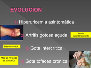 Remite
espontáneamente
Meses o años
Mas de 10 años
de evolución
1) Hiperuricemia asintomática
2) Artritis gotosa aguda
3) Gota intercrítica
4) Gota tofácea crónica
 