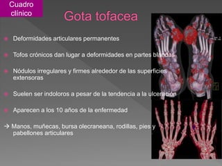  Deformidades articulares permanentes
 Tofos crónicos dan lugar a deformidades en partes blandas
 Nódulos irregulares y firmes alrededor de las superficies
extensoras
 Suelen ser indoloros a pesar de la tendencia a la ulceración
 Aparecen a los 10 años de la enfermedad
 Manos, muñecas, bursa olecraneana, rodillas, pies y
pabellones articulares
Cuadro
clínico
 