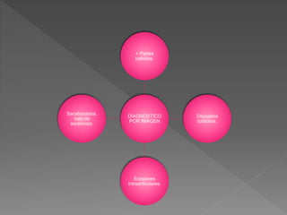 DIAGNÓSTICO
POR IMAGEN
+ Partes
balndas.
Depositos
tofáceos.
Erosiones
intraarticulares.
Sacabocados,
halo de
esclerosis.
 