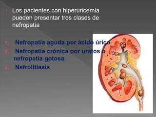 • Los pacientes con hiperuricemia
pueden presentar tres clases de
nefropatía
1. Nefropatía aguda por ácido úrico
2. Nefropatía crónica por uratos o
nefropatía gotosa
3. Nefrolitiasis
 