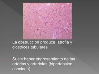 • La obstrucción produce atrofia y
cicatrices tubulares
• Suele haber engrosamiento de las
arterias y arteriolas (hipertensión
asociada)
 