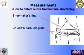 Bahaa Ali Kornah-Al-Azhar Un. Cairo. EGYPT
Measurements
(How to detect supra trochanteric shortening
l Shoemaker's line.
l Chiene’s parallelogram
 