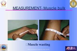 Bahaa Ali Kornah-Al-Azhar Un. Cairo. EGYPT
MEASUREMENT- Muscle bulk
Muscle wasting
 
