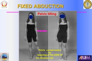 Bahaa Ali Kornah-Al-Azhar Un. Cairo. EGYPT
FIXED ABDUCTION
Pelvic tilting
Pelvis compensates
by
lowering of the ASIS of
the diseased side
 