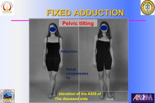 Bahaa Ali Kornah-Al-Azhar Un. Cairo. EGYPT
FIXED ADDUCTION
Pelvic tilting
Adduction
Pelvis
compensates
by
elevation of the ASIS of
The diseased side
 