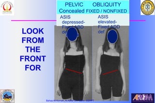 Bahaa Ali Kornah-Al-Azhar Un. Cairo. EGYPT
LOOK
FROM
THE
FRONT
FOR
PELVIC OBLIQUITY
Concealed FIXED / NONFIXED
ASIS
depressed-
Fixed ABD
def
ASIS
elevated-
Fixed ADD
def
Bahaa Ali Kornah_Al.Azhar Un. Cairo . EGYPT
 