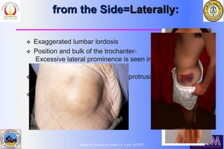 Bahaa Ali Kornah-Al-Azhar Un. Cairo. EGYPT
from the Side=Laterally:
 Exaggerated lumbar lordosis
 Position and bulk of the trochanter-
Excessive lateral prominence is seen in
subluxation/dislocation.
 Reduced prominence seen with protrusio
acetabuli.
 Scars sinuses or any abnormal
prominences
 