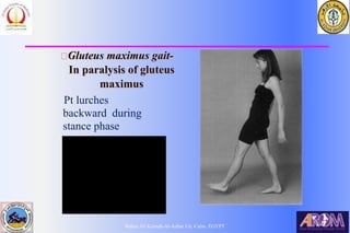 Bahaa Ali Kornah-Al-Azhar Un. Cairo. EGYPT
Gluteus maximus gait-
In paralysis of gluteus
maximus
Pt lurches
backward during
stance phase
 