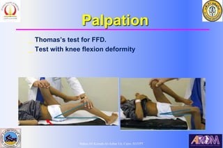 Bahaa Ali Kornah-Al-Azhar Un. Cairo. EGYPT
Palpation
_ Thomas’s test for FFD.
_ Test with knee flexion deformity
 