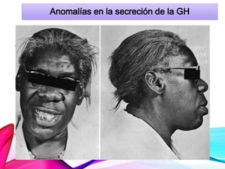 Anomalías en la secreción de la GH
Acromegalia
 Después de la adolescencia
 Aumento de grosor óseo y tejidos blandos.
 Huesos membranosos:
Manos, pies, cráneo y mandíbula
 