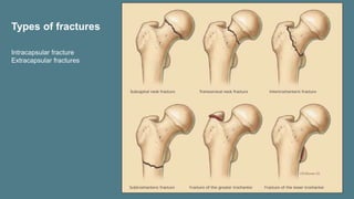 Types of fractures
Intracapsular fracture
Extracapsular fractures
 