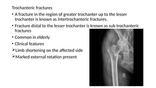 Hip fractures and THR ppt.pptx types of fractures | PPTX