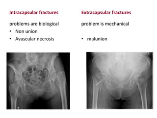 Intracapsular fractures
problems are biological
• Non union
• Avascular necrosis
Extracapsular fractures
problem is mechanical
• malunion
 