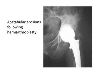 Acetabular erosions
following
hemiarthroplasty
 