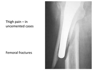 Thigh pain – in
uncemented cases
Femoral fractures
 