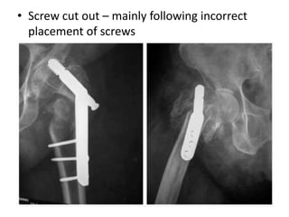 • Screw cut out – mainly following incorrect
placement of screws
 