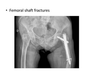 • Femoral shaft fractures
 