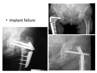 • Implant failure
 