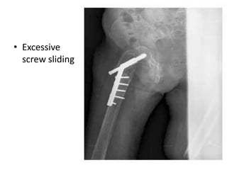 • Excessive
screw sliding
 