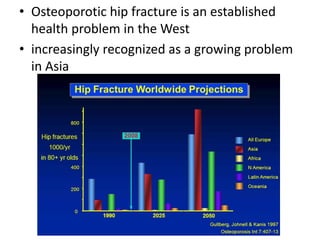 • Osteoporotic hip fracture is an established
health problem in the West
• increasingly recognized as a growing problem
in Asia
 