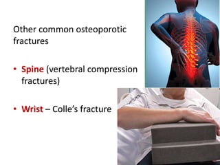 Other common osteoporotic
fractures
• Spine (vertebral compression
fractures)
• Wrist – Colle’s fracture
 