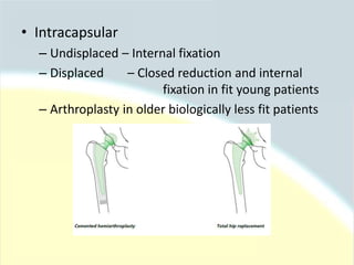 • Intracapsular
– Undisplaced – Internal fixation
– Displaced – Closed reduction and internal
fixation in fit young patients
– Arthroplasty in older biologically less fit patients
 