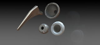 Hip bone implant-Reverse Engineered 
