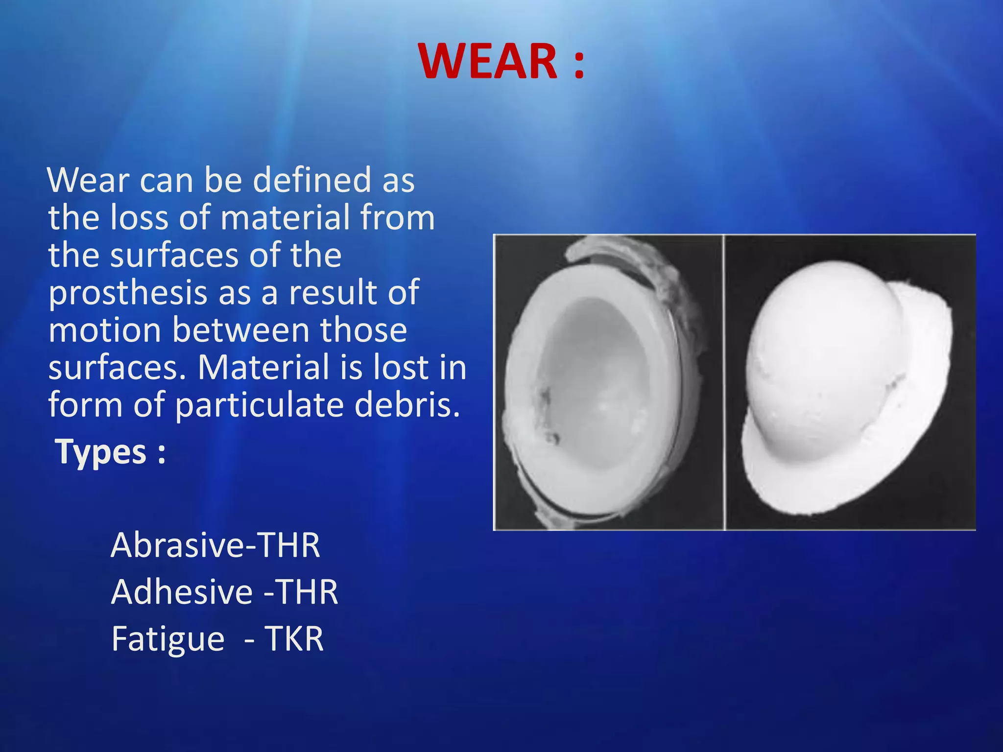 WEAR :
Wear can be defined as
the loss of material from
the surfaces of the
prosthesis as a result of
motion between those
surfaces. Material is lost in
form of particulate debris.
Types :
Abrasive-THR
Adhesive -THR
Fatigue - TKR

 