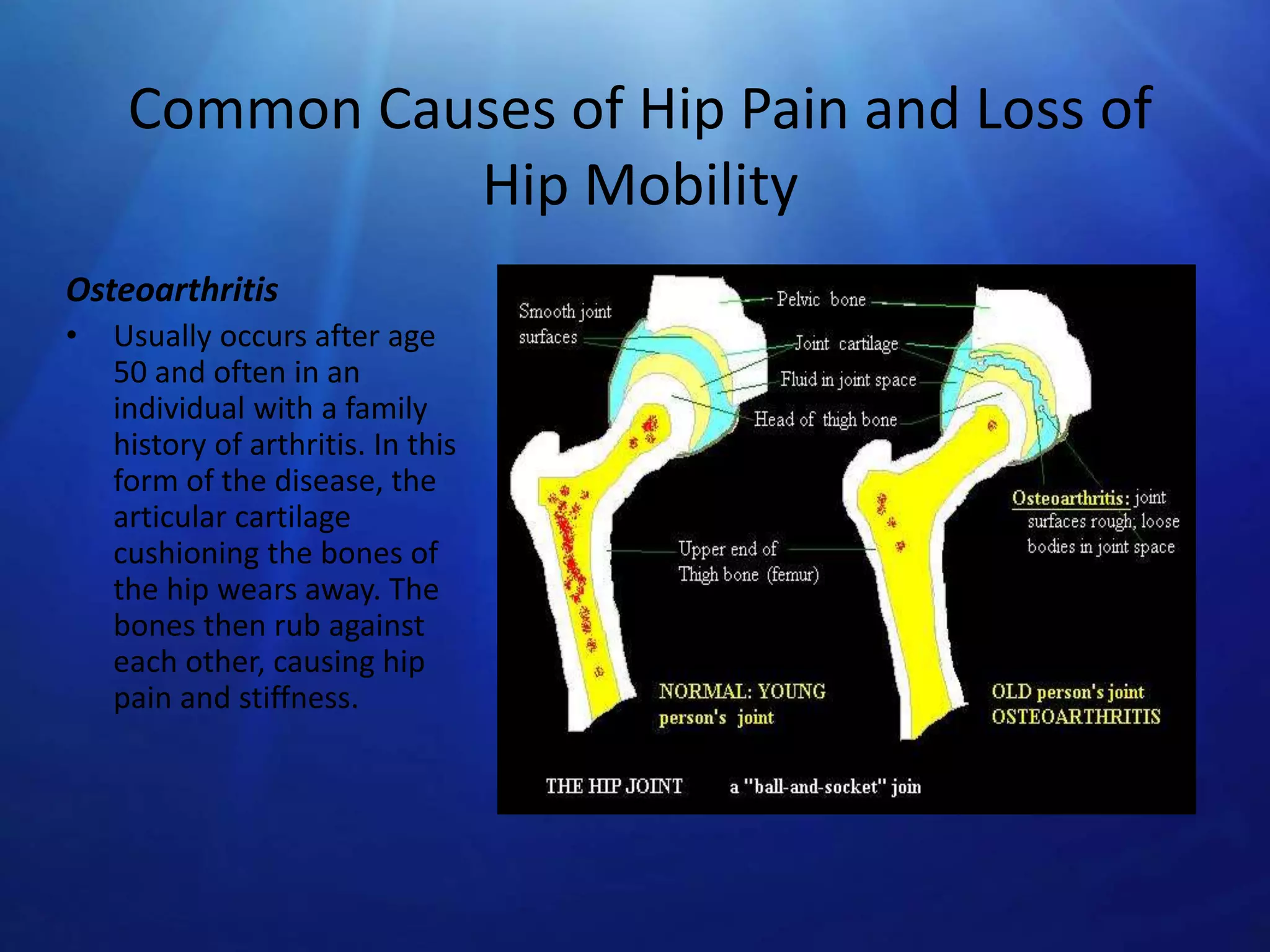 Common Causes of Hip Pain and Loss of
Hip Mobility
Osteoarthritis
•

Usually occurs after age
50 and often in an
individual with a family
history of arthritis. In this
form of the disease, the
articular cartilage
cushioning the bones of
the hip wears away. The
bones then rub against
each other, causing hip
pain and stiffness.

 