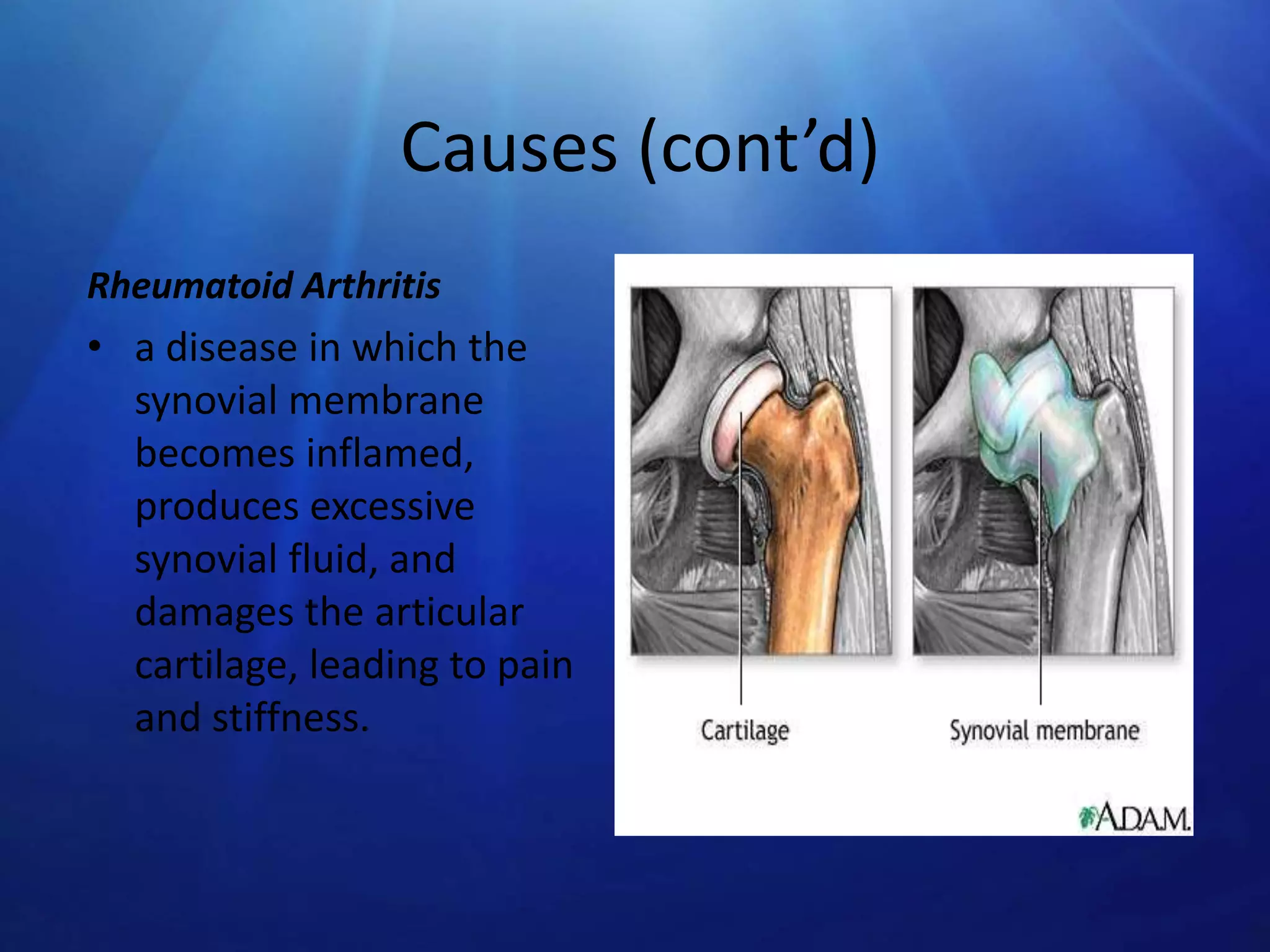 Causes (cont’d)
Rheumatoid Arthritis

• a disease in which the
synovial membrane
becomes inflamed,
produces excessive
synovial fluid, and
damages the articular
cartilage, leading to pain
and stiffness.

 