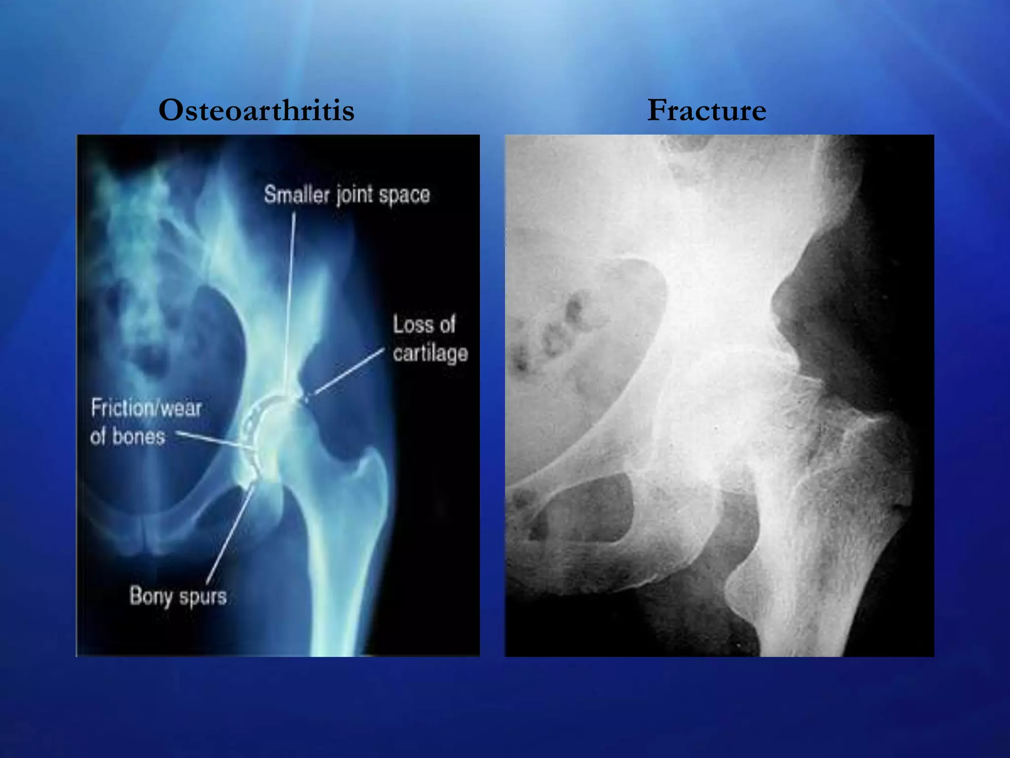 Osteoarthritis

Fracture

 