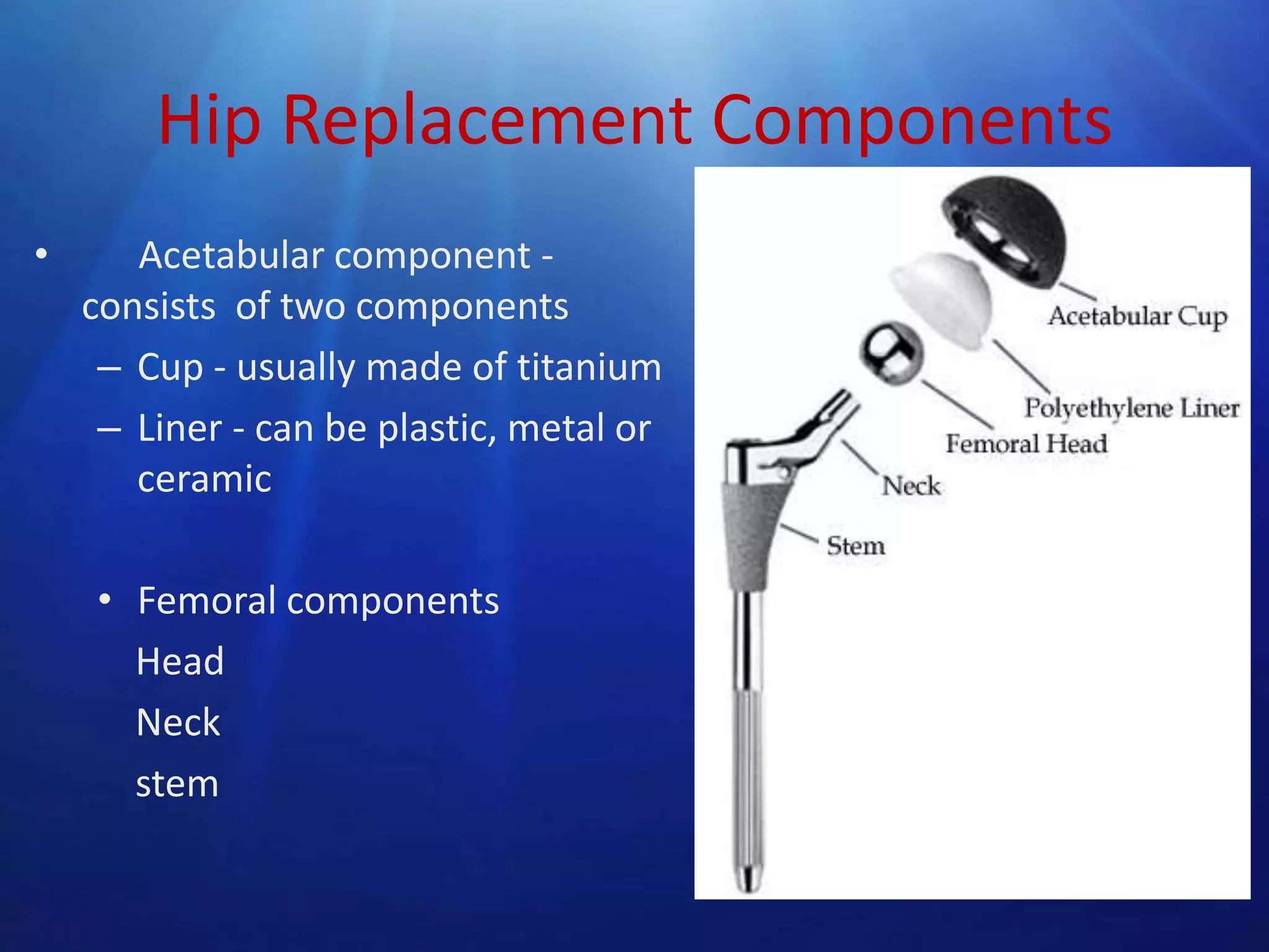 Hip Replacement Components
•

Acetabular component consists of two components
– Cup - usually made of titanium
– Liner - can be plastic, metal or
ceramic
• Femoral components
Head
Neck
stem

 