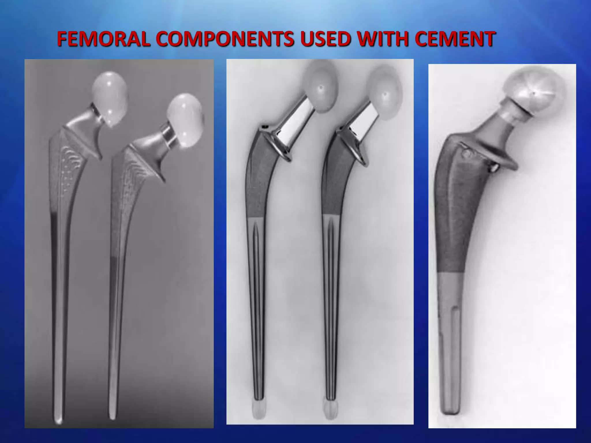 FEMORAL COMPONENTS USED WITH CEMENT

 