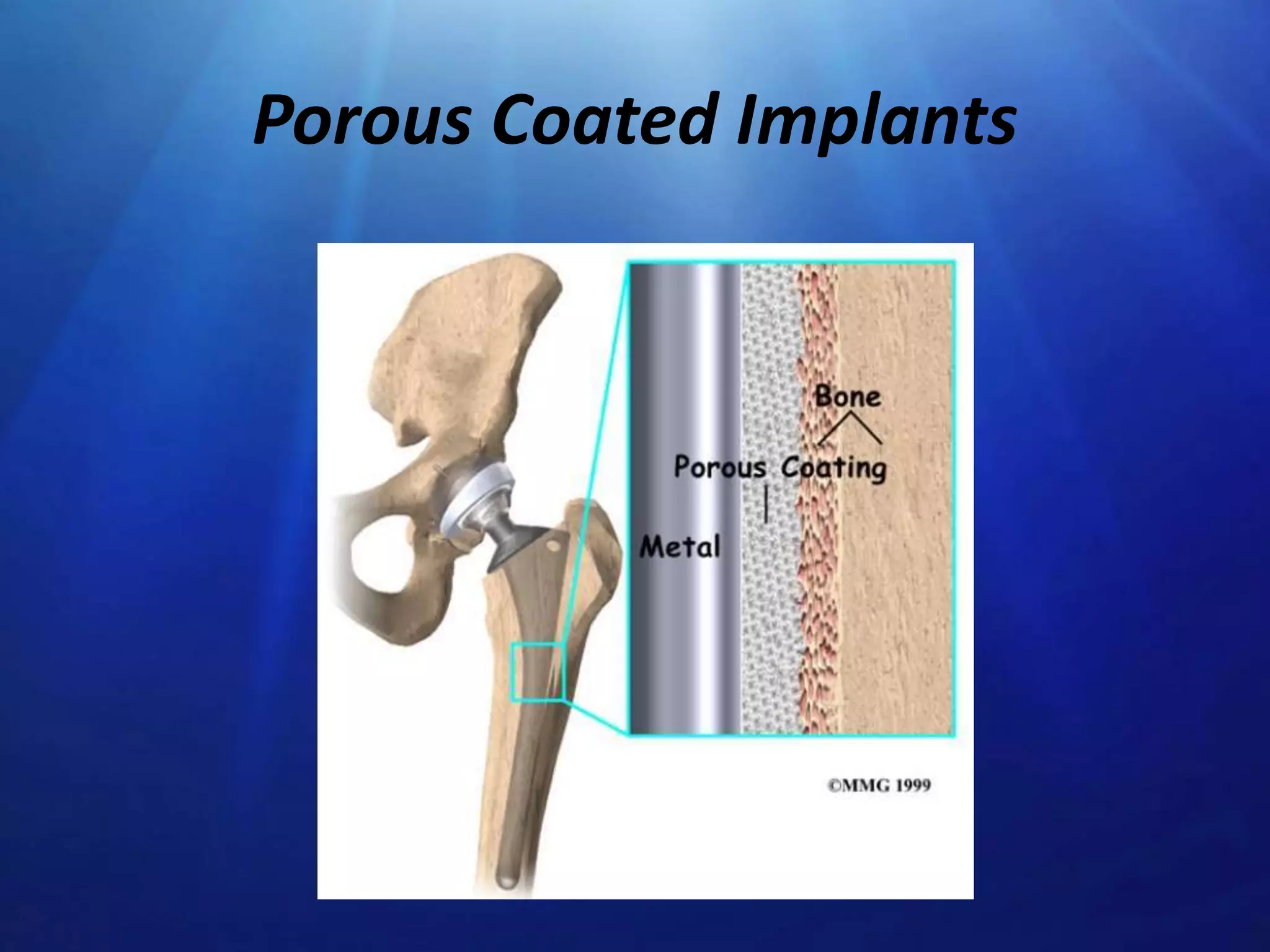 Porous Coated Implants

 