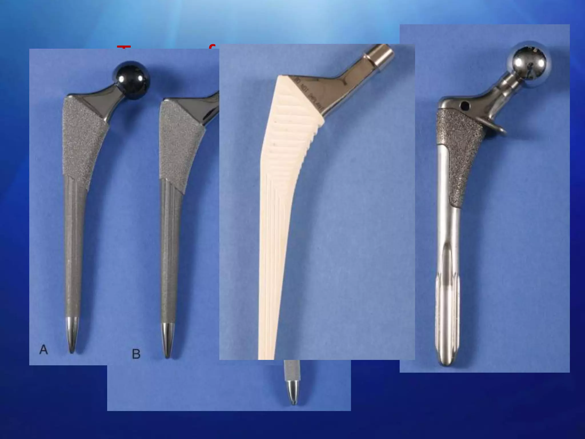 Types of porous coated stems
• Circumferential porous coating-first
generation femoral stems
• Extensive coated stems
• Proximally coated stem – twice the incidence
of thigh pain(stem tip abutment on the
anterior cortex of femur)
• Tapered femoral stems
• Stems with hydroxyapetite coatings

 