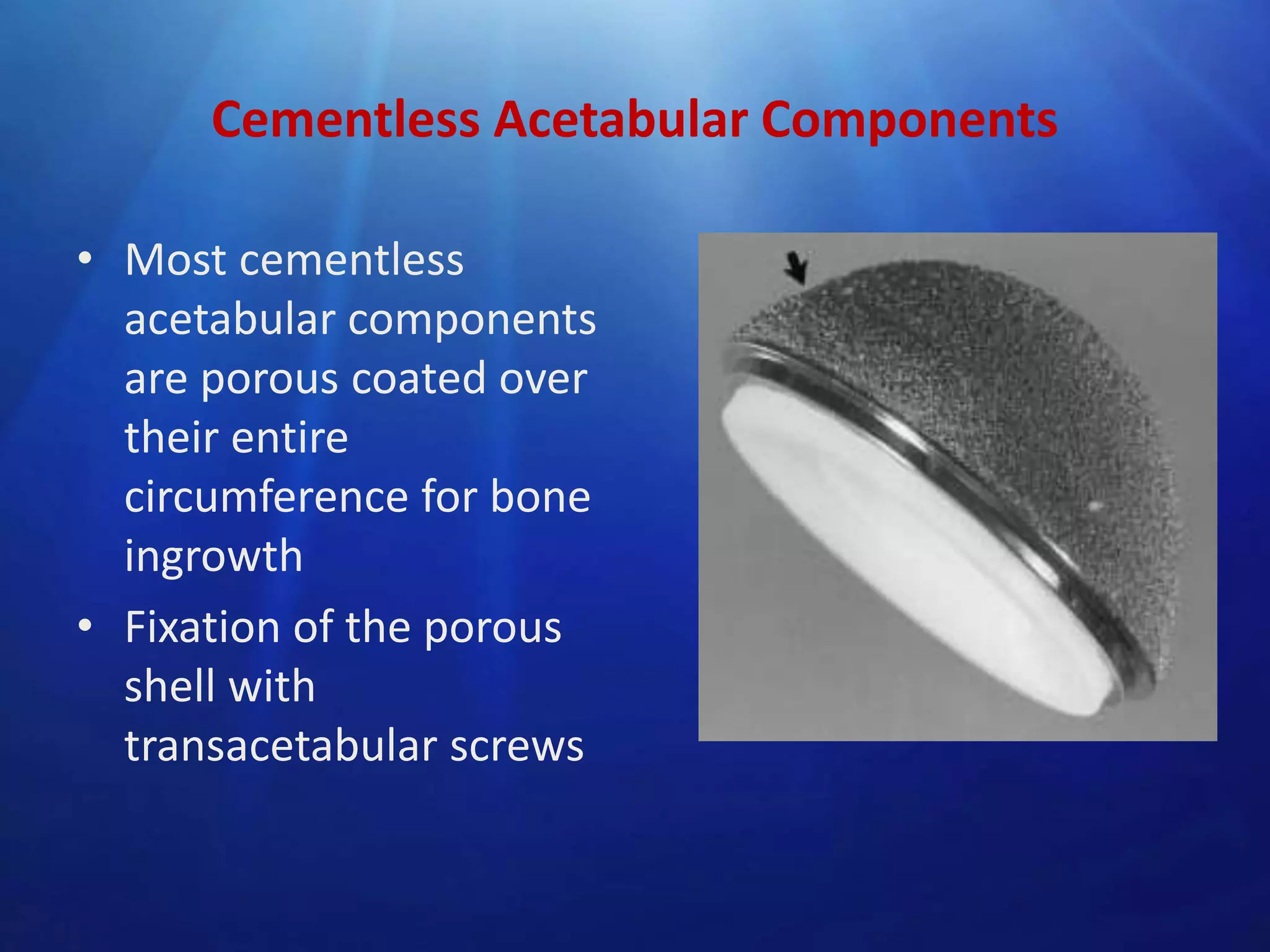 Cementless Acetabular Components
• Most cementless
acetabular components
are porous coated over
their entire
circumference for bone
ingrowth
• Fixation of the porous
shell with
transacetabular screws

 