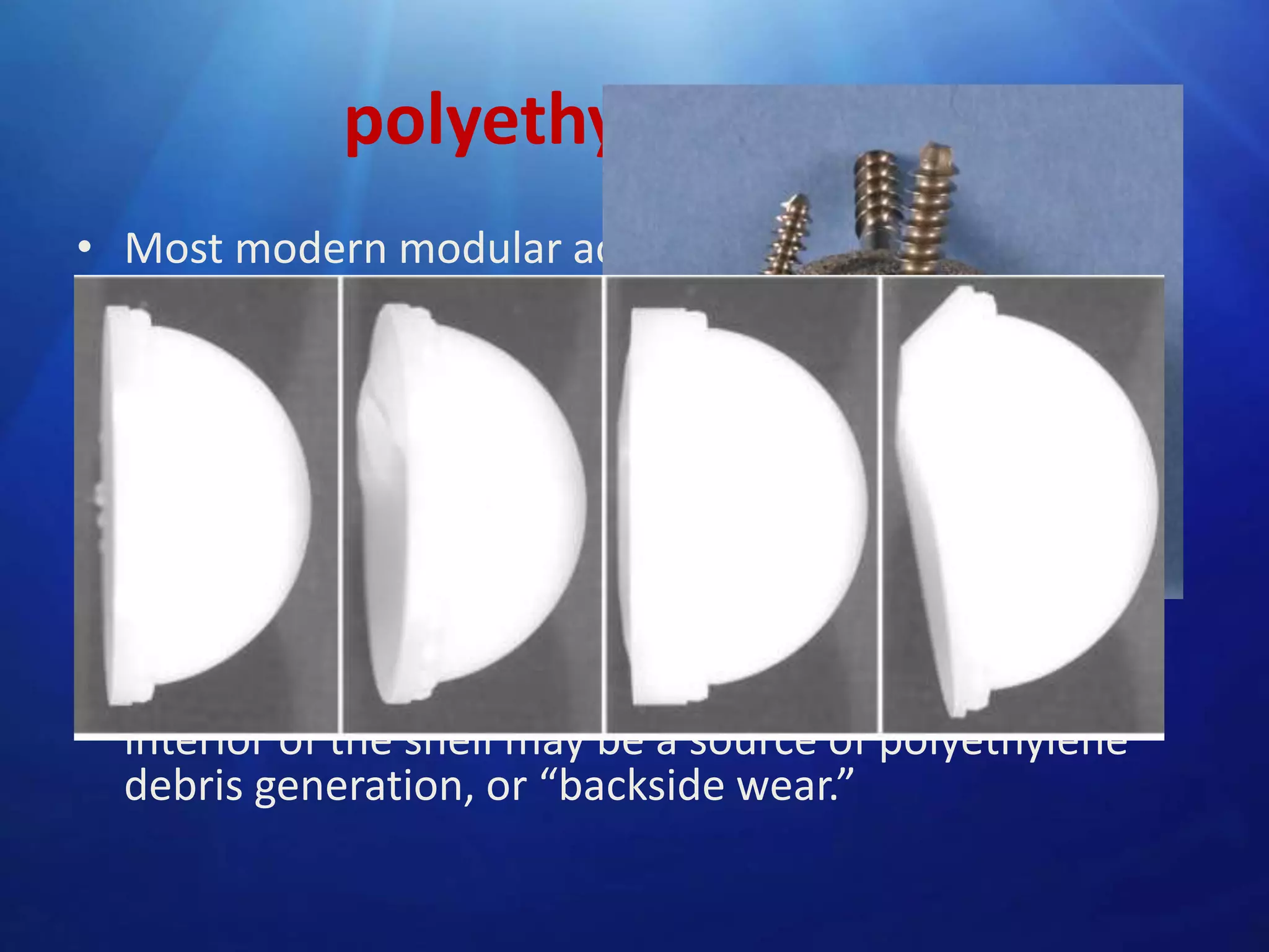 polyethylene liner
• Most modern modular acetabular components are
supplied with a variety of polyethylene liner choices
• The polyethylene liner must be fastened securely to
the metal shell.
• Current mechanisms include plastic flanges and metal
wire rings that lock behind elevations or ridges in the
metal shell, and peripherally placed screws
• in vivo dissociation of polyethylene liners from their
metal backings has been reported micromotion
between the nonarticulating side of the liner and the
interior of the shell may be a source of polyethylene
debris generation, or “backside wear.”

 