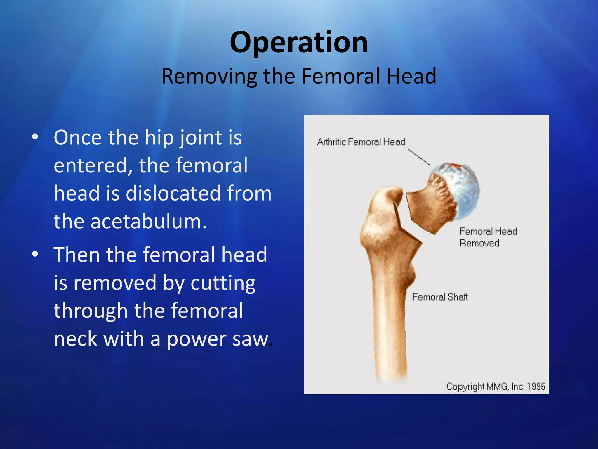 Operation
Removing the Femoral Head
• Once the hip joint is
entered, the femoral
head is dislocated from
the acetabulum.
• Then the femoral head
is removed by cutting
through the femoral
neck with a power saw.

 