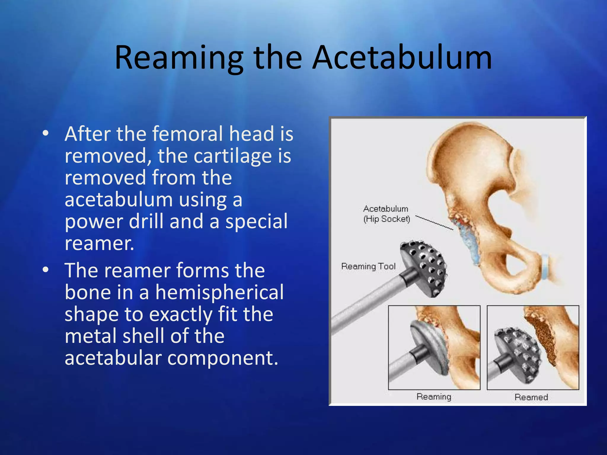 Reaming the Acetabulum
• After the femoral head is
removed, the cartilage is
removed from the
acetabulum using a
power drill and a special
reamer.
• The reamer forms the
bone in a hemispherical
shape to exactly fit the
metal shell of the
acetabular component.

 