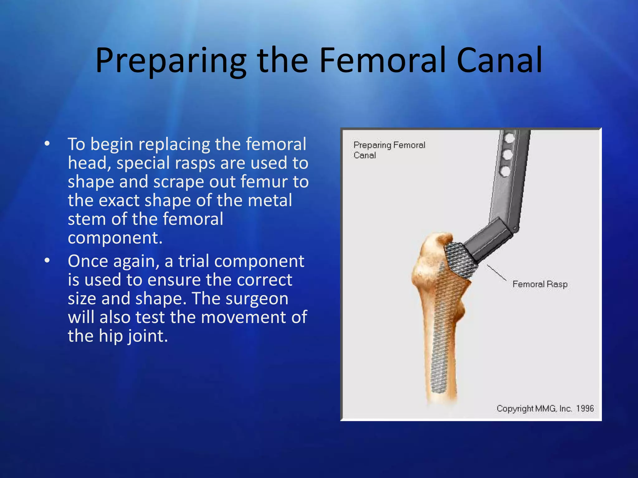 Preparing the Femoral Canal
• To begin replacing the femoral
head, special rasps are used to
shape and scrape out femur to
the exact shape of the metal
stem of the femoral
component.
• Once again, a trial component
is used to ensure the correct
size and shape. The surgeon
will also test the movement of
the hip joint.

 