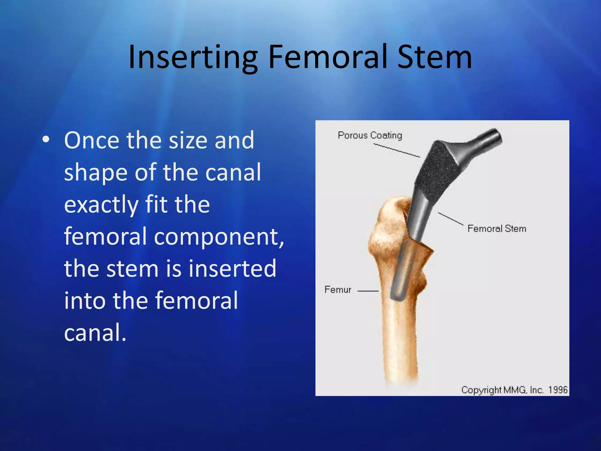 Inserting Femoral Stem
• Once the size and
shape of the canal
exactly fit the
femoral component,
the stem is inserted
into the femoral
canal.

 